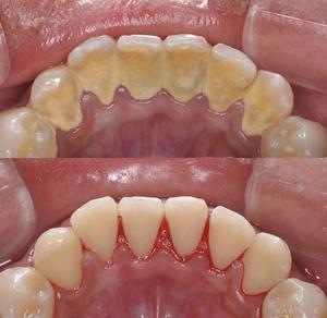 Limpiezas Dentales