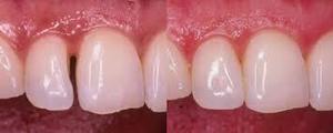 Restauraciones Dentales