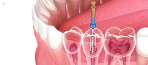 Tratamiento de Conductos (Endodoncia)
